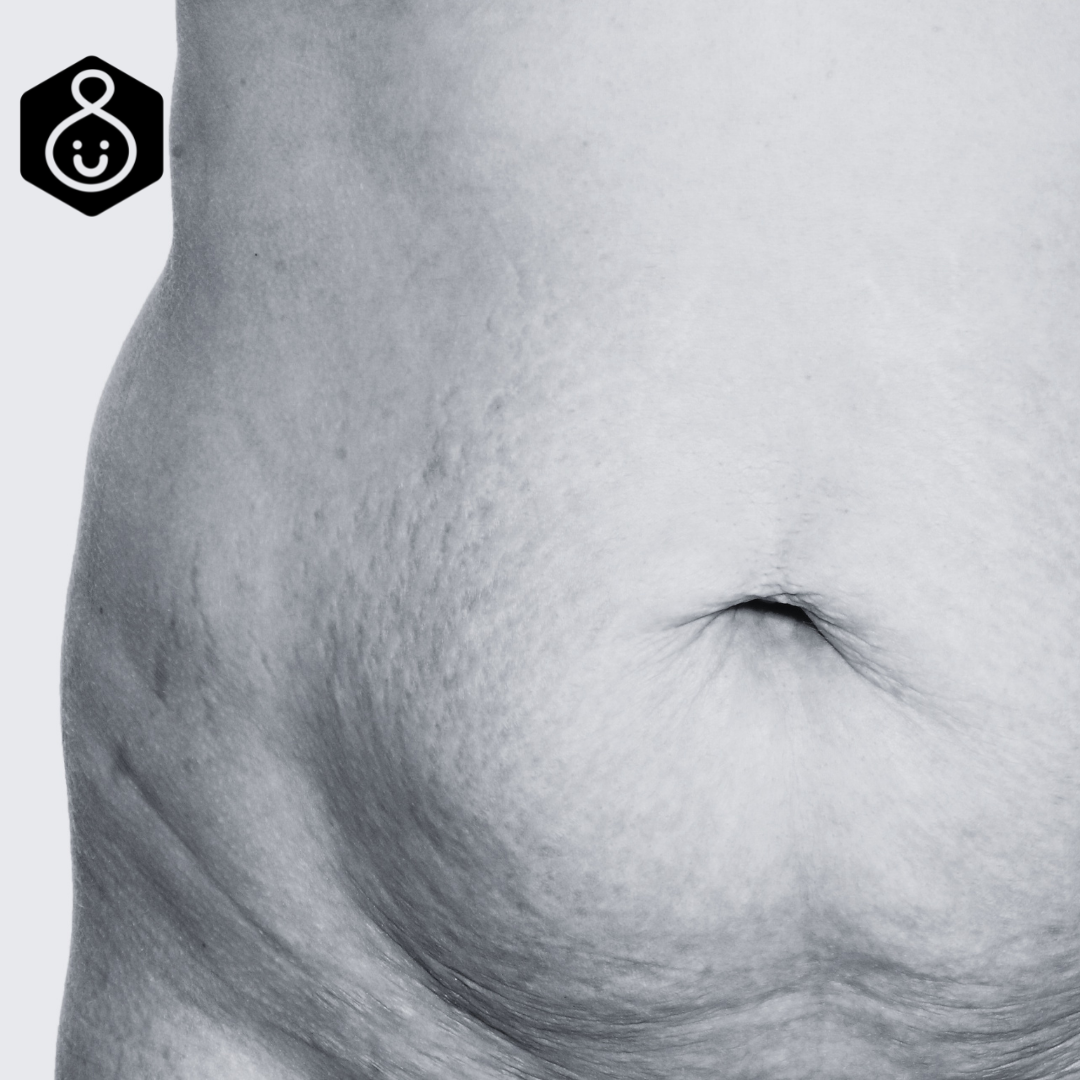 A mom's stomach after giving birth: Understanding postpartum weight